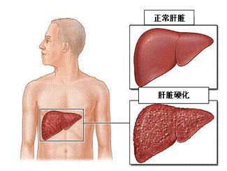 乙肝怎么预防肝硬化和肝癌?